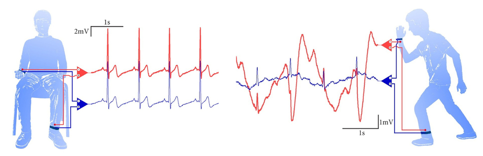 À gauche : Les électrodes textiles donnent des ECG (en bleu) d'aussi bonne qualité que ceux d'électrodes classiques (en rouge) pour un patient assis. À droite : Pour un patient en mouvement, les ECG d'électrodes textiles (bleu) sont plus précis que les ECG d'électrodes classiques (rouge). 