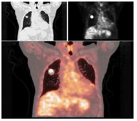 The last image is obtained by superimposing the first two images, slices of a thorax from two complementary techniques traditionally used in oncology 