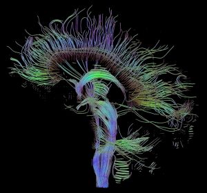 Reconstruction tractographique des connexions du cerveau par imagerie du tenseur de diffusion.