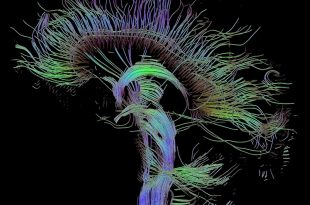Reconstruction tractographique des connexions du cerveau par imagerie du tenseur de diffusion.
