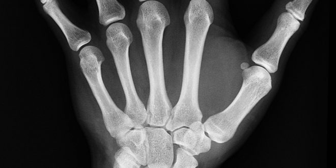 Il est possible de cacher des informations sur le propriétaire de cette main dans les pixels de la radiographie. C'est le principe du tatouage.