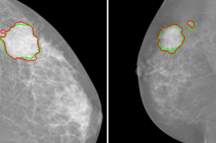 Mieux détecter les zones tumorales est essentiel pour limiter les faux positifs lors des dépistages du cancer du sein.