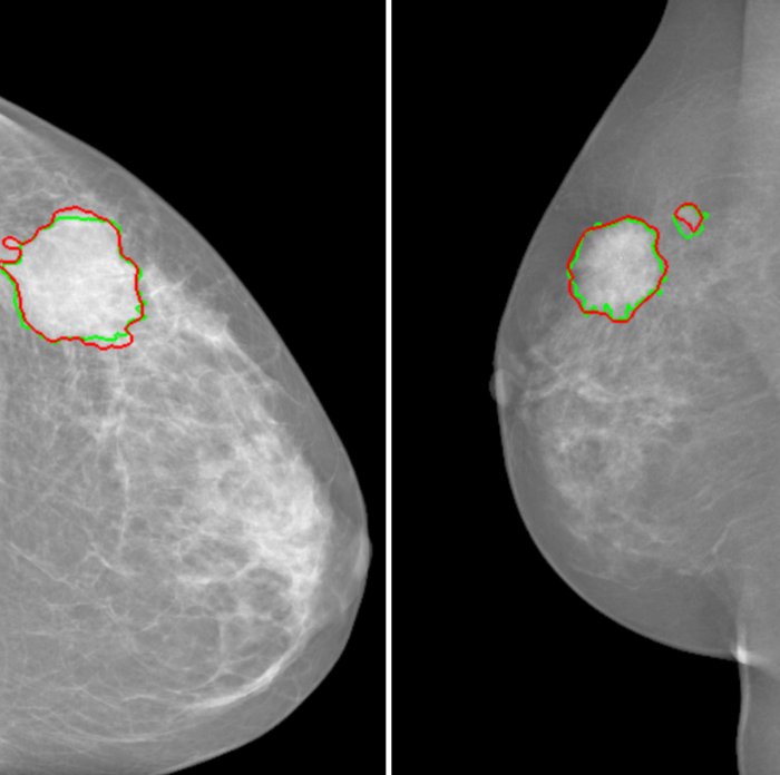 Mieux détecter les zones tumorales est essentiel pour limiter les faux positifs lors des dépistages du cancer du sein.
