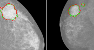 breast cancer