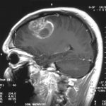 Le glioblastome est une forme de tumeur du cerveau. Son traitement est encore difficile. Image : Christaras A / Wikimedia.