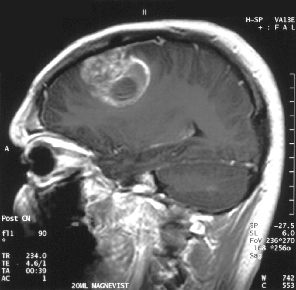 Le glioblastome est une forme de tumeur du cerveau. Son traitement est encore difficile. Image : Christaras A / Wikimedia.