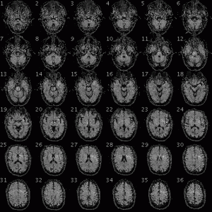 L'IRMf produit des images de coupe du cerveau avec une bonne résolution spatiale, mais une mauvaise résolution temporelle.